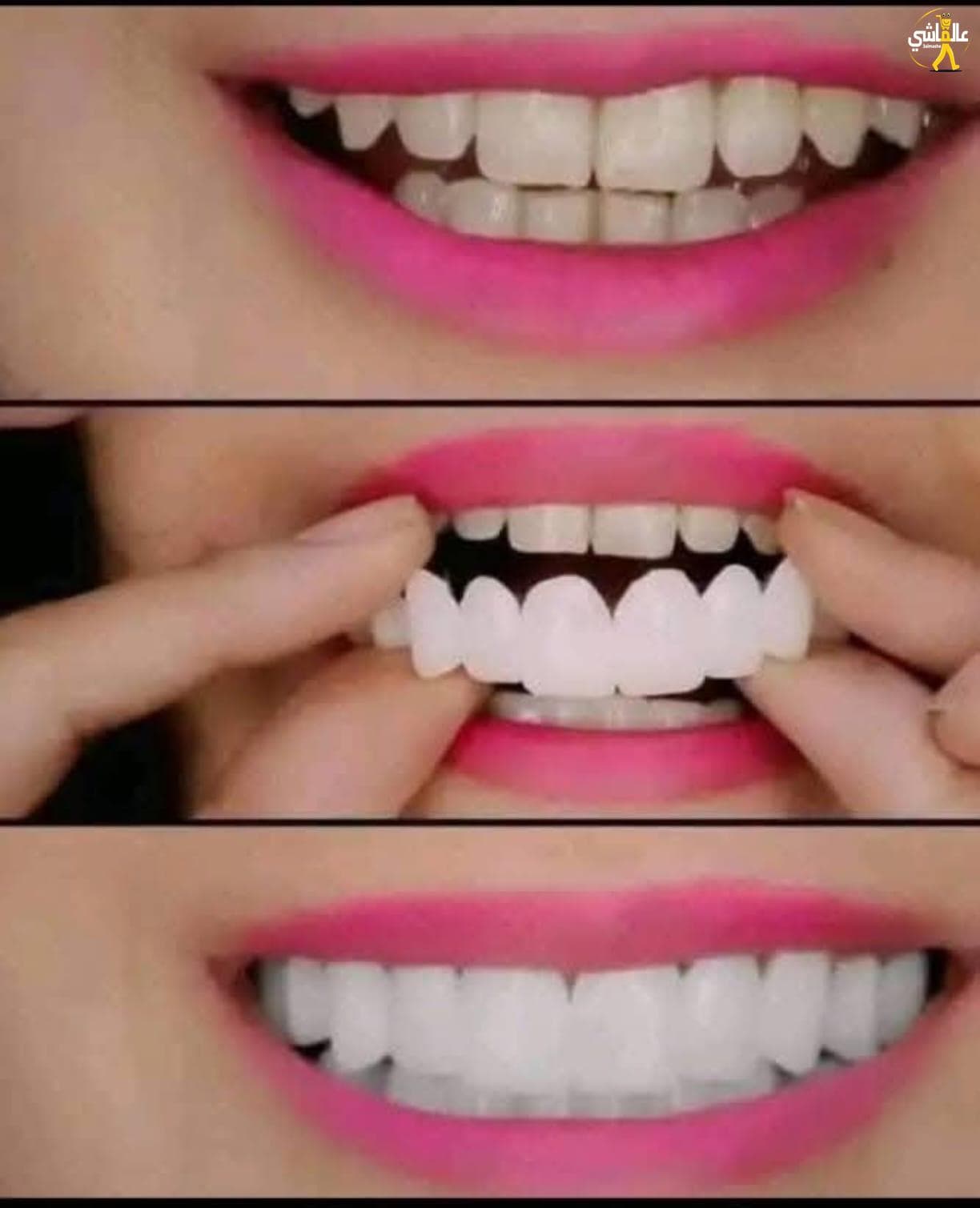 عرض تركيب الأسنان كل سن 10 دولار وفي بي 15 دولار